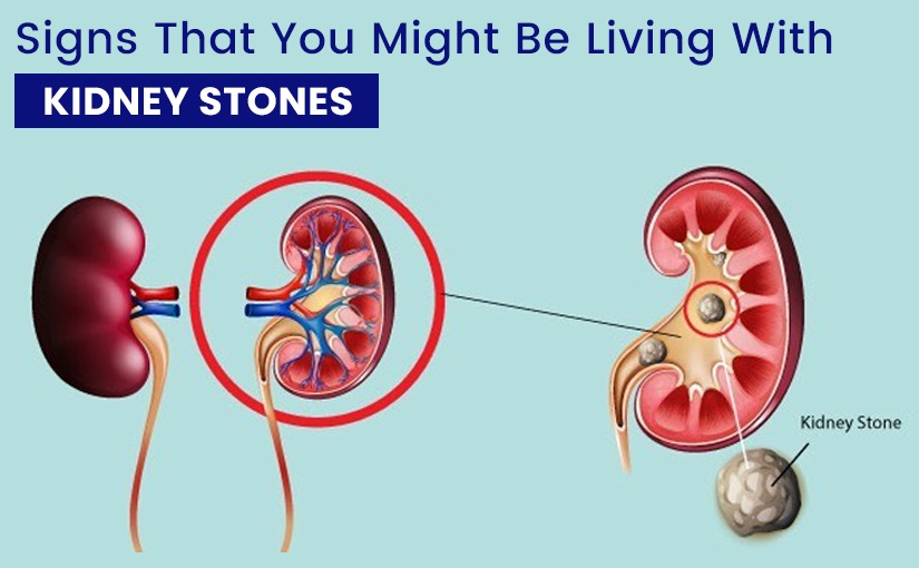 Signs That You Might Be Living With Kidney Stones Kalpit Healthcare