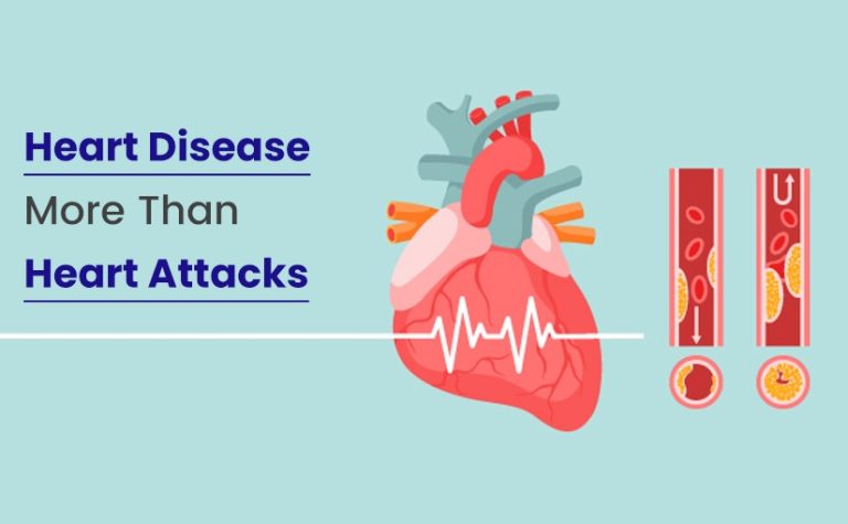 Heart Disease More Than Heart Attacks