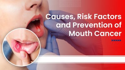 Causes, Risk Factors, and Prevention of Mouth Cancer